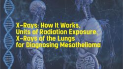 X-Rays: How It Works, Units of Radiation Exposure, X-Rays of the Lungs for Diagnosing Mesothelioma