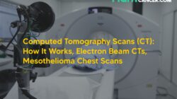 Computed Tomography Scans (CT): How It Works, Electron Beam CTs, Mesothelioma Chest Scans