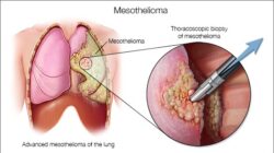 Understanding Mesothelioma Cancer: Causes, Symptoms, and Treatment